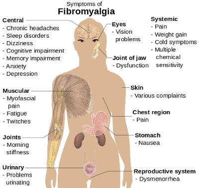Physical Therapy Treatment for Fibromyalgia - prohealthcareproducts.com