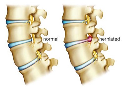 How To Treat Herniated Discs with Physical Therapy