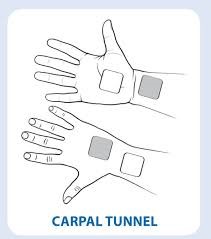 https://www.prohealthcareproducts.com/product_images/uploaded_images/tens-electrode-placement-for-carpal-tunnel.jpg