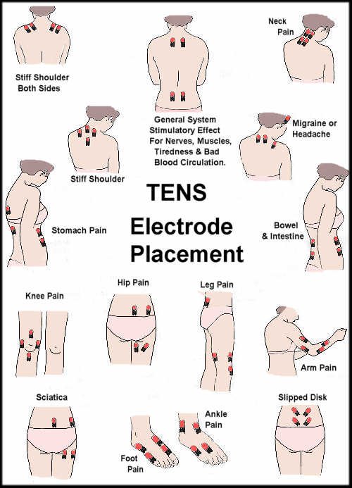 https://www.prohealthcareproducts.com/product_images/uploaded_images/tens-unit-placement-guide-full-body.jpg